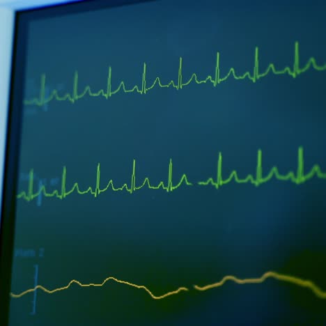 motion of graphics on the screen of monitor. monitor displays patient's vital signs ecg. oxygen saturation and respiration. close-up.