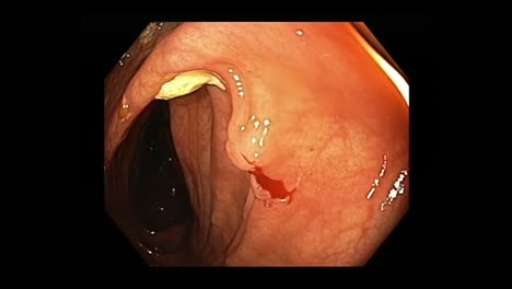 多重切除 (polypectomy) 的方法