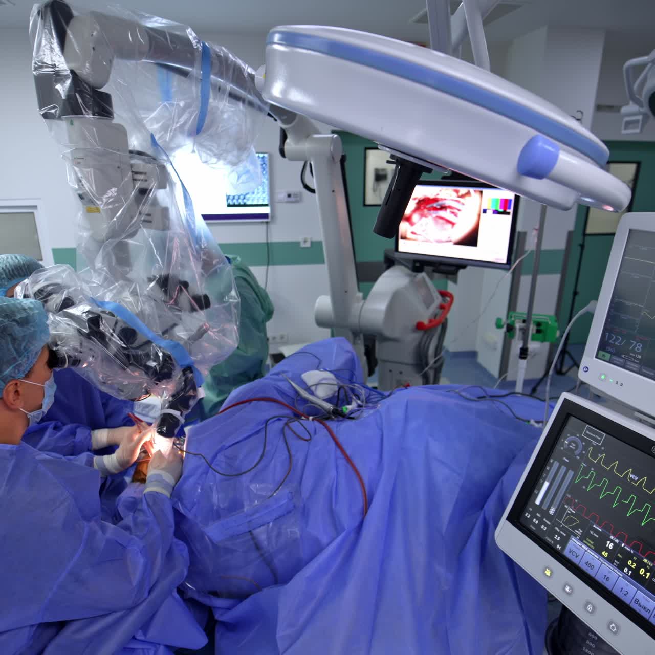 Neurosurgical professionals conducting operation in well-equipped surgery room. Two screens from lung ventilation system show the life parameters of a patient