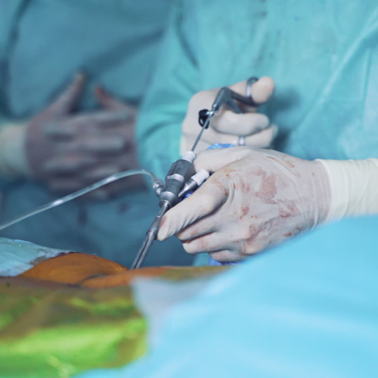Special instrument for operation in surgeon's hands. Operating process in a surgery room. Close-up of sterile gloves with some blood holding modern equipment during the operation.