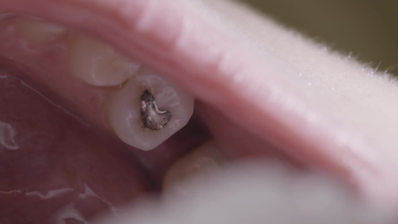 Close-up of a dental procedure: Amalgam filling