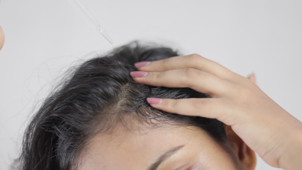 Androgenic alopecia, hairloss, a young woman with dropper applying hair serum on alopecia head to treat hairloss.