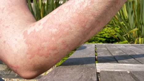 man shows bad outbreak of hives on skin