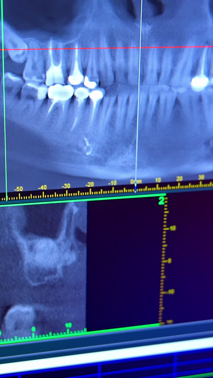 X-ray of oral cavity with teeth. Close up of digital orthopantomography for dental diagnosis. Vertical video