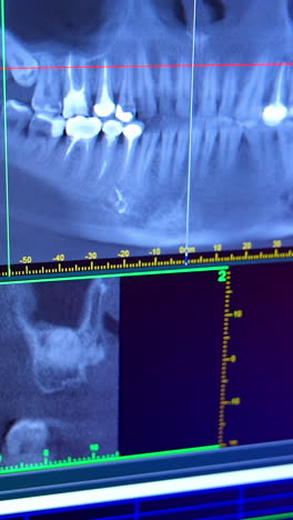 x-ray of oral cavity with teeth. close up of digital orthopantomography for dental diagnosis. vertical video