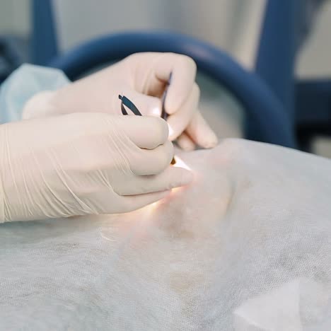 laser vision correction