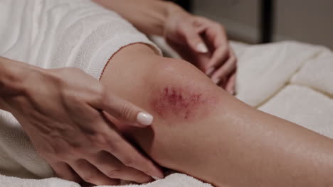 woman with a bruised knee