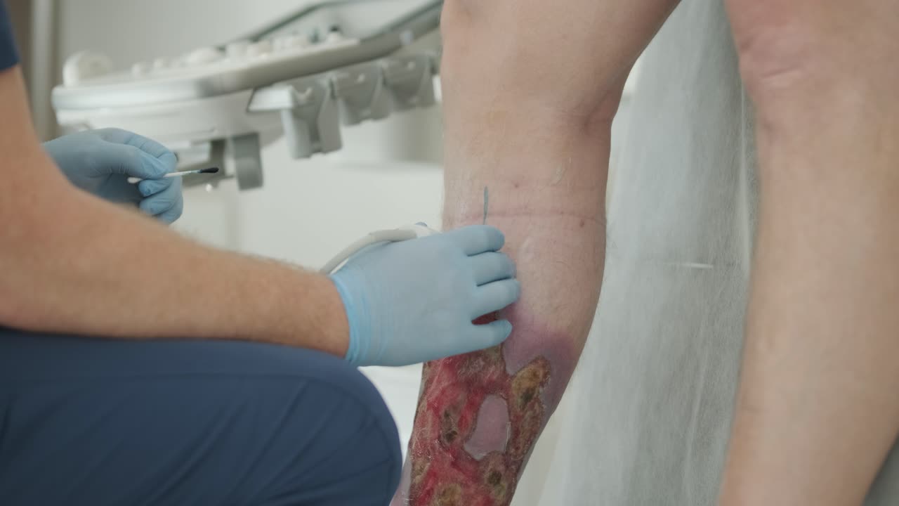 examen médico por ultrasonido en un paciente con úlcera en la pierna