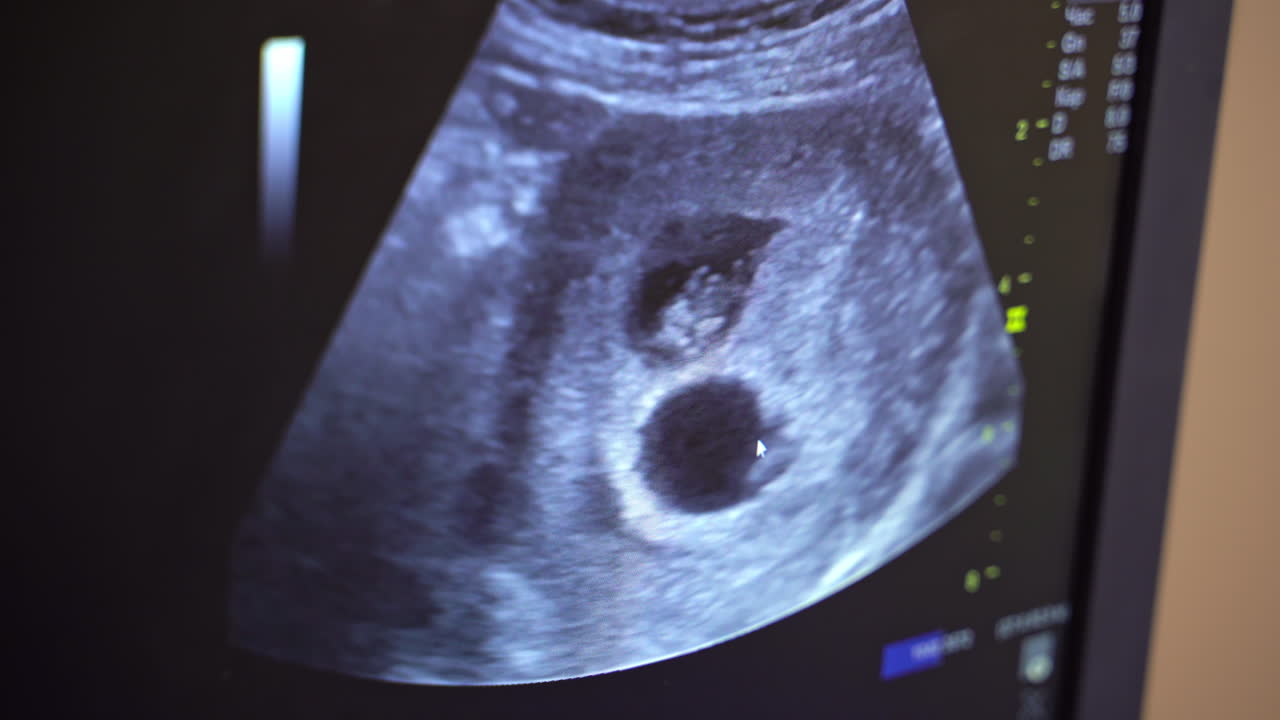Sonography. The screen of the ultrasound machine. Results of the ultrasound on the monitor. Health care concept.