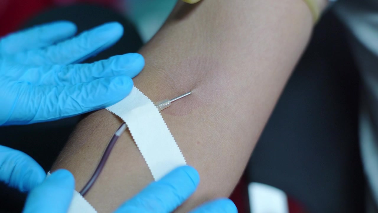 Primo piano di un avambraccio con un ago inserito nella vena e un tubicino endovenoso fissato con nastro adesivo.