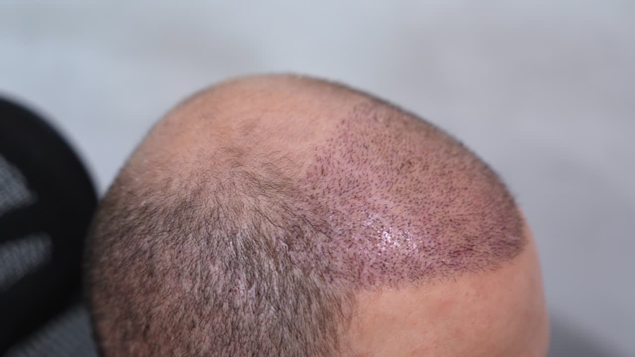 Detailed close-up of a shaved scalp with fresh hair transplant grafts and visible implantation marks, showing post-procedure recovery in a clinical cosmetic treatment context