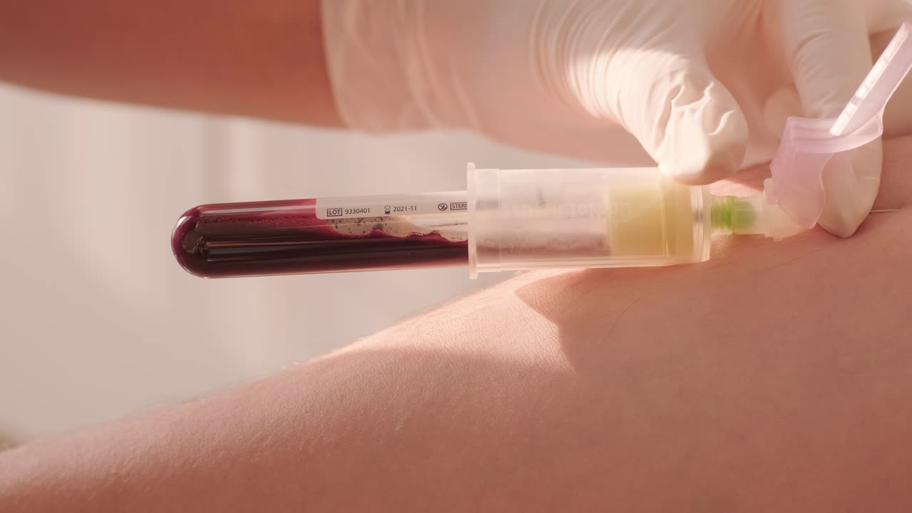 muestreo de sangre. plasma rico en plaquetas prp utilizado en el tratamiento de lesiones.