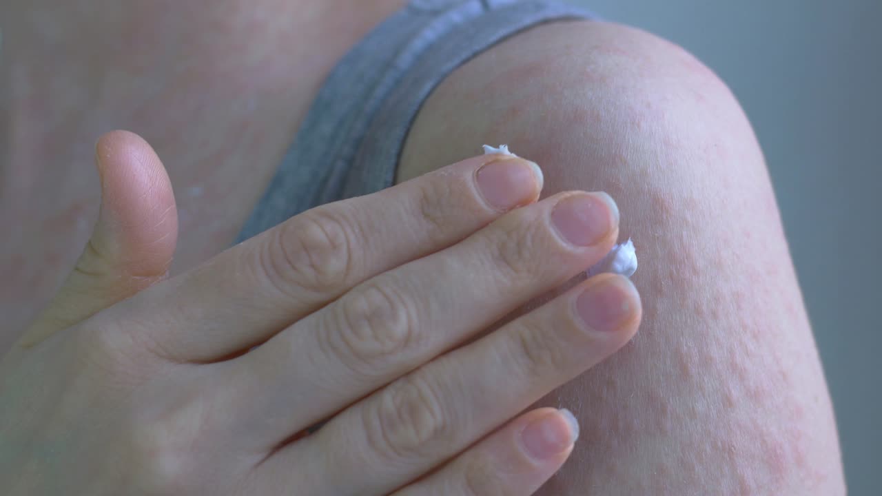 피부에 알레르기 반응을 나타니다. 다양한 크기의 은색 반점이 있습니다. 기름은 손가락으로 적용되고 피부의 염증 부위에 철저하게 어집니다.