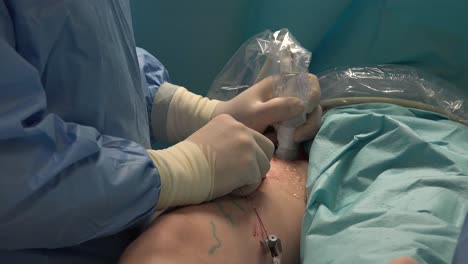 endovenous laser ablation is a commonly used and very effective minimally invasive therapy to manage leg varicosities