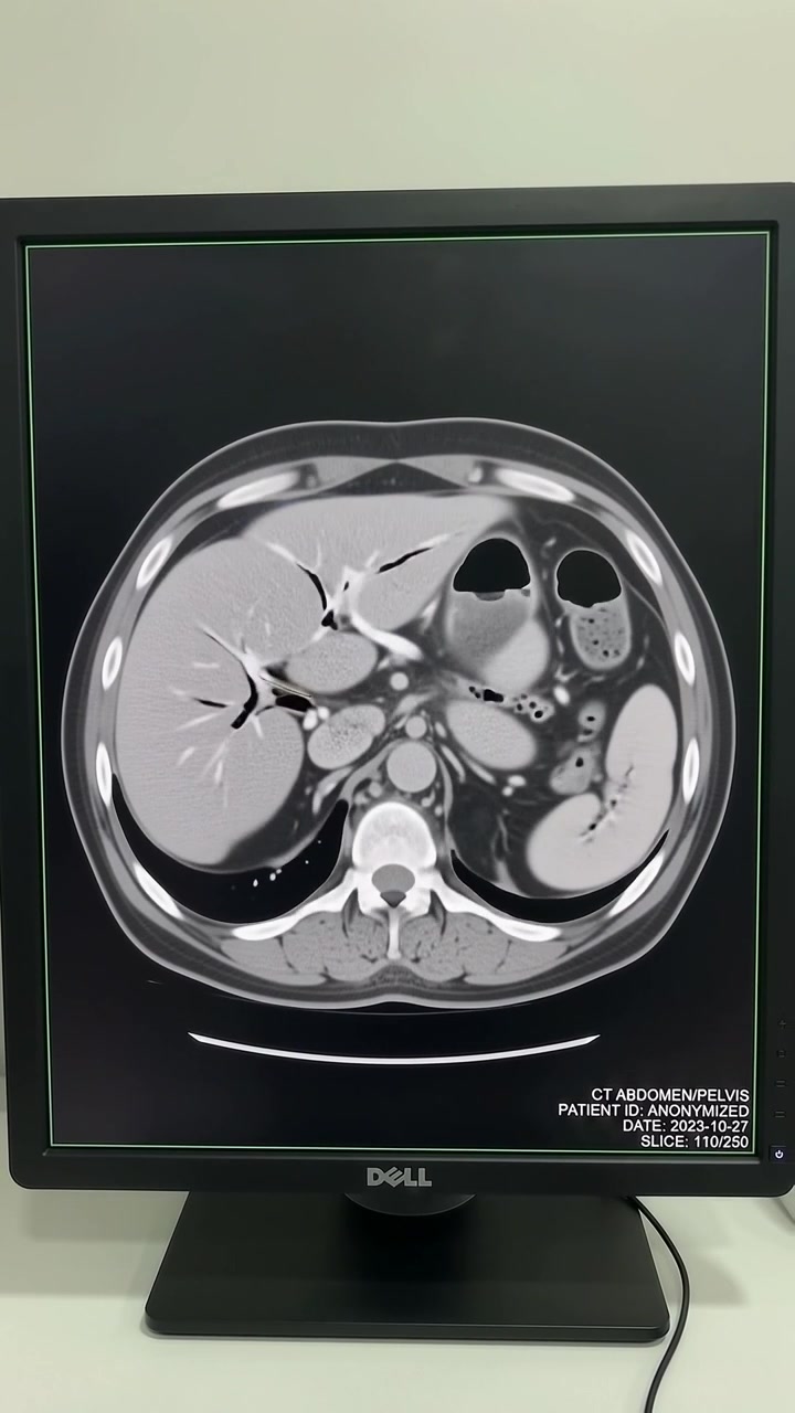 Medical CT Scan of Human Abdomen Displayed on Computer Monitor