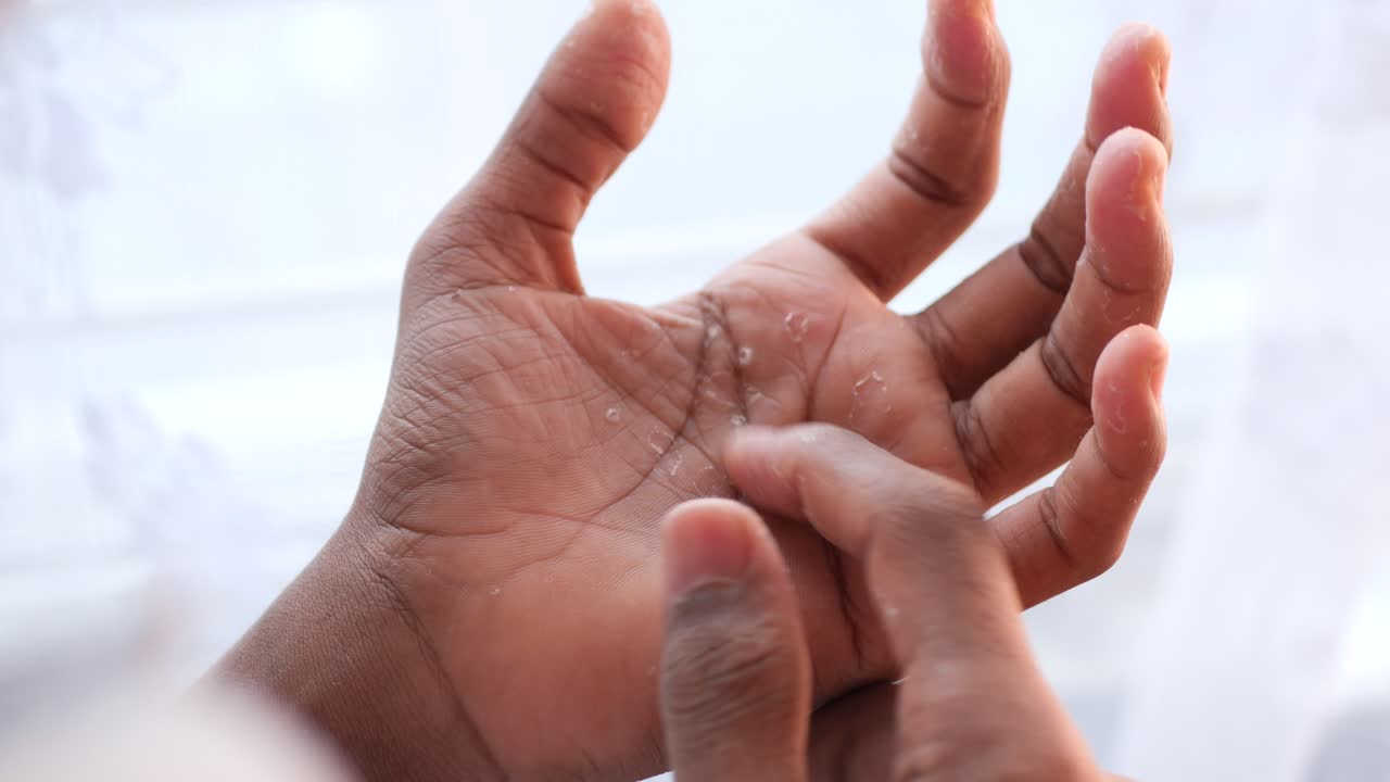 piel seca y erupción en las manos