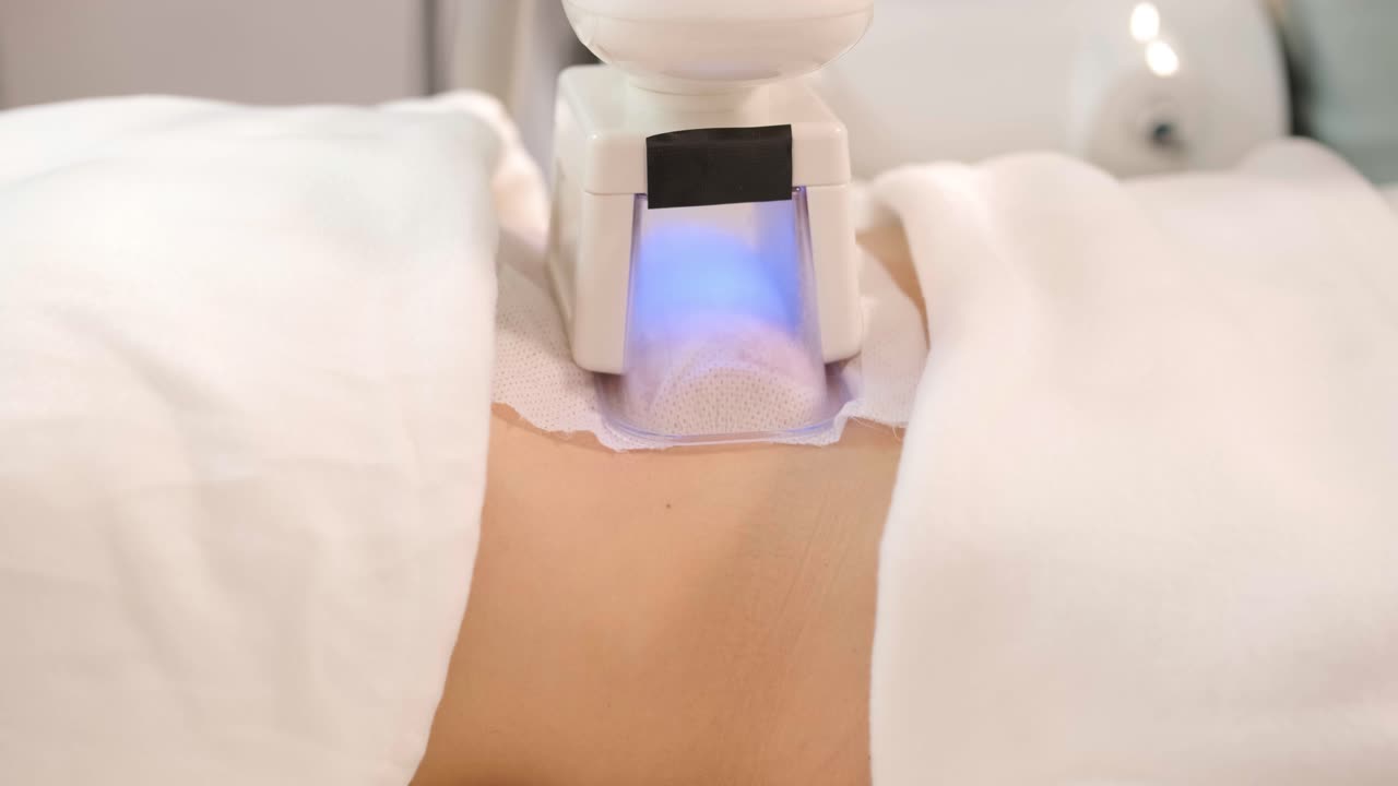 сриолиполиз процедура обработки жира в современной косметологической клинике