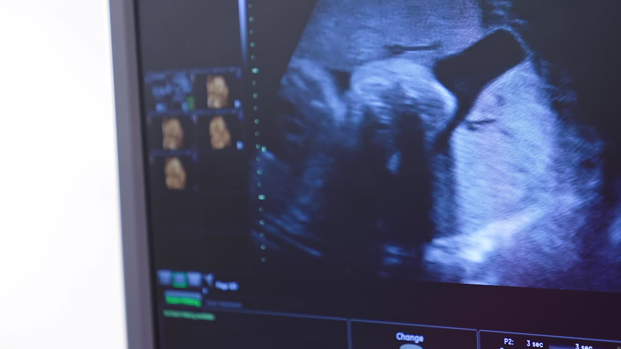 Dynamic ultrasound image of an embryo on screen. Tiny baby is turning in mother's belly. Baby in mother's womb is moving during sonography. Close-up.