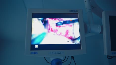 modern equipment in the surgery room. operation on the monitor. process of endoscopic operation is depicted on the screen in clinic.