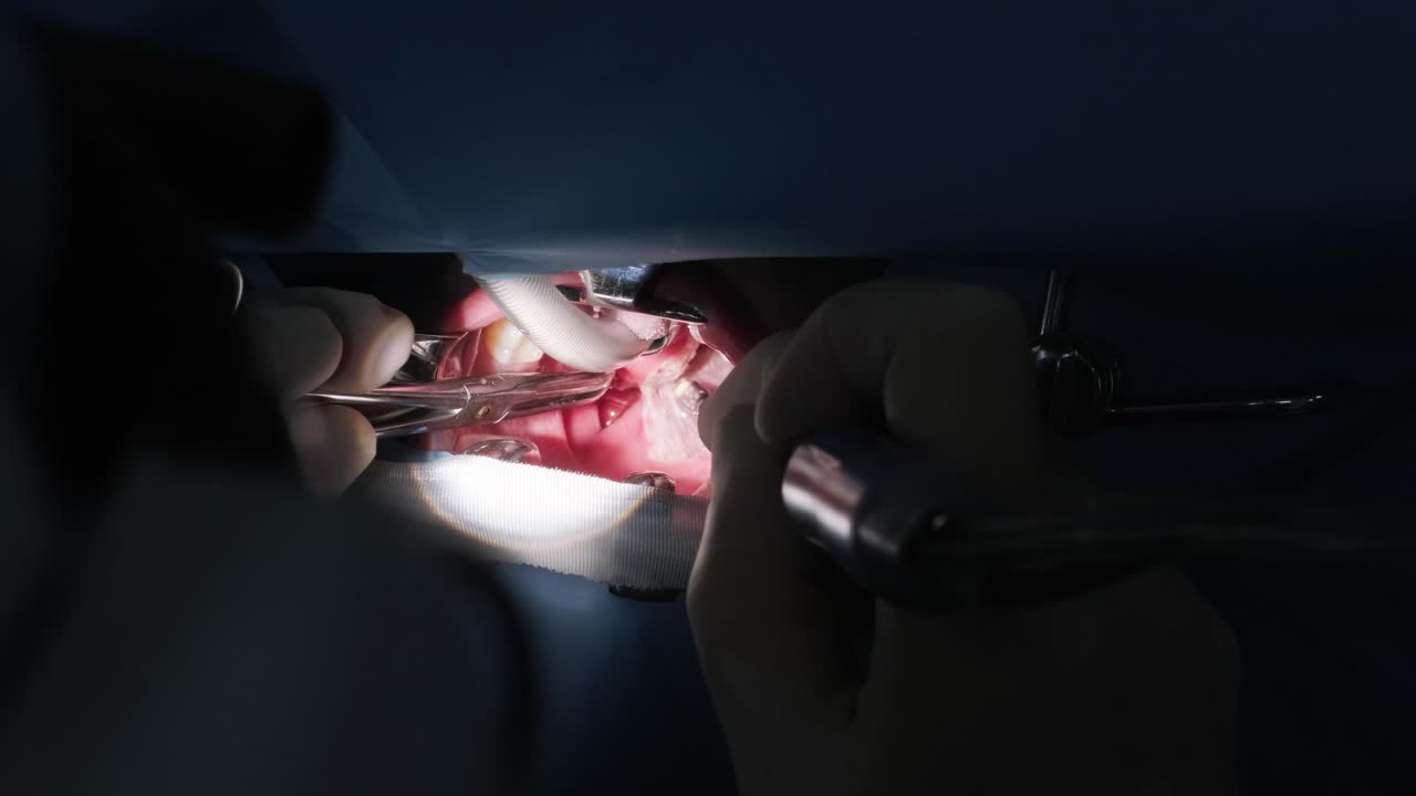 Operation of removing tonsils under deep anesthesia, throat close up, surgeon uses latest devices, cold plasma method, cuts swelling in throat, doctor works with new probe