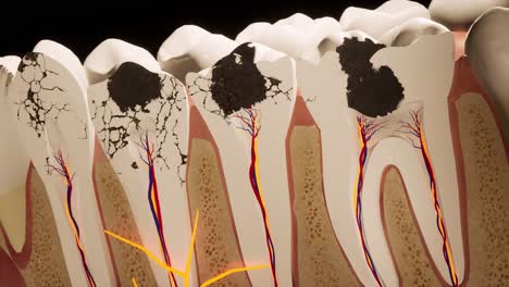 molar teeth damaged by caries. medically accurate tooth 3d animation