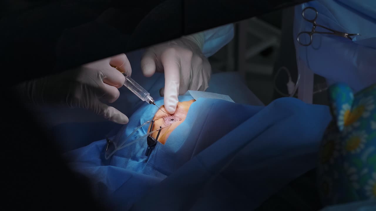 Correzione della vista con il laser. Un paziente e un team di chirurghi nella sala operatoria durante un intervento di chirurgia oftalmica. Divaricatore palpebrale. Trattamento Lasik. Paziente sotto copertura sterile