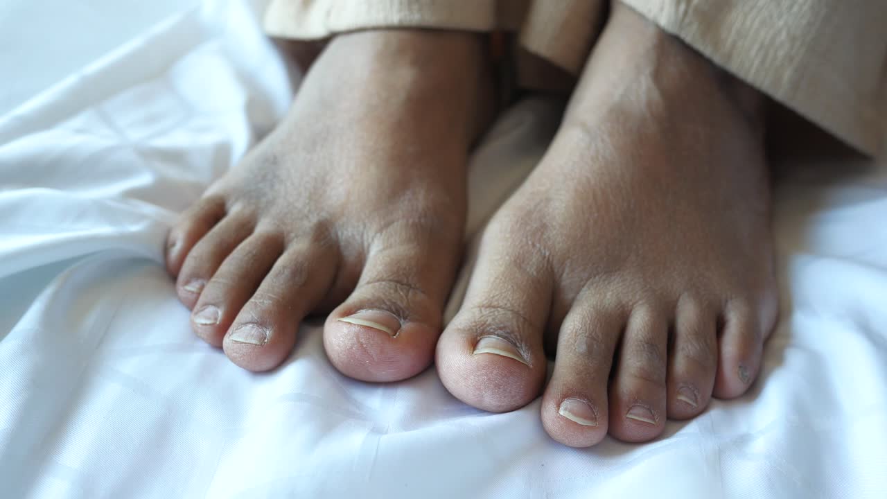 Dry, Cracked Feet: Causes, Prevention and Treatment