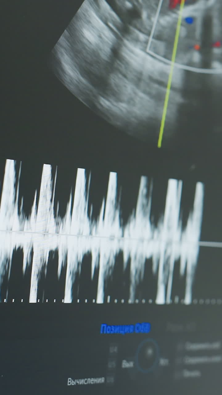 ultrasound monitor showing fetal heartbeat waveform in obstetric clinic as sonographer records pulsed Doppler spectral tracing, white spike patterns and measurement calipers visible, technician