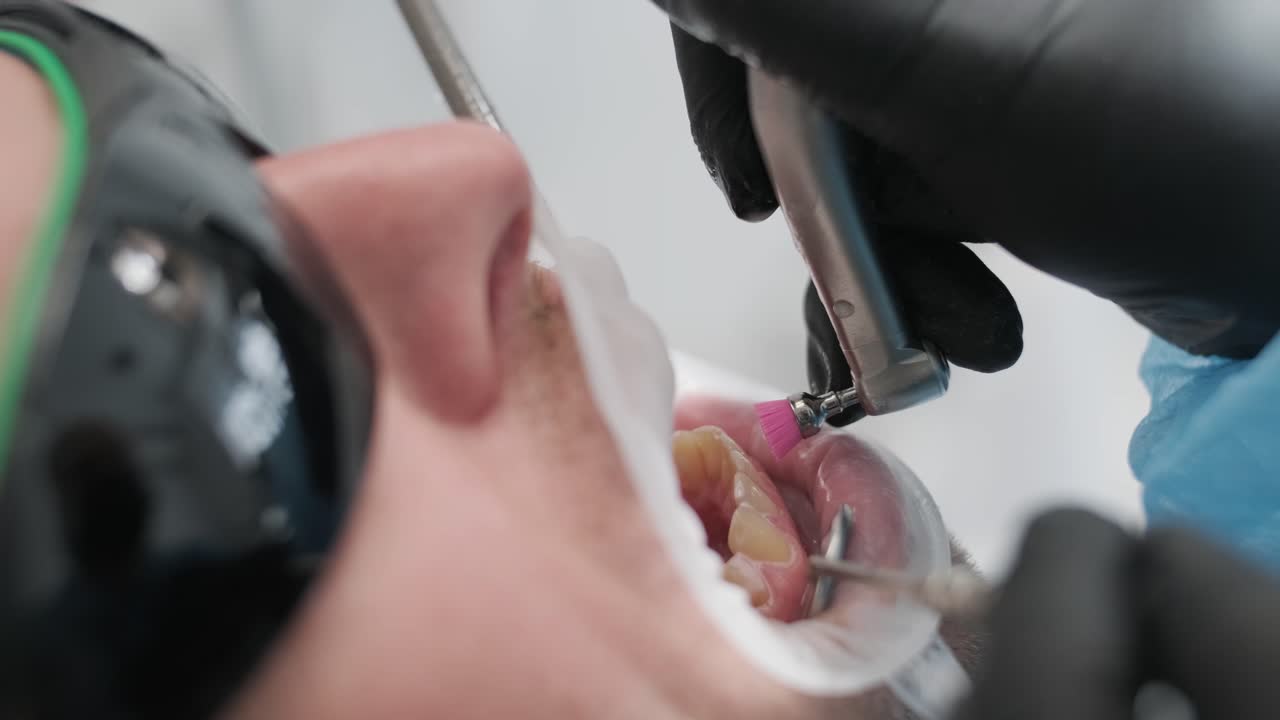 Teeth whitening procedure. Tooth whitening gel. Dentist does the whitening procedure