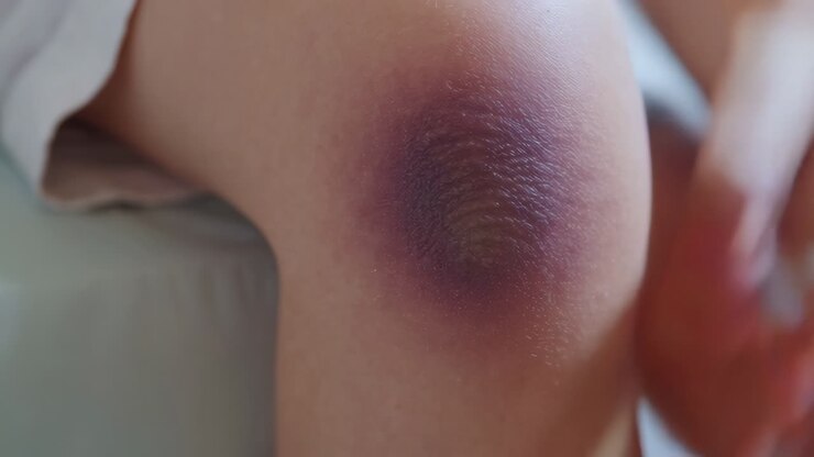 Bruised Knee