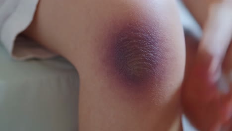 bruised knee
