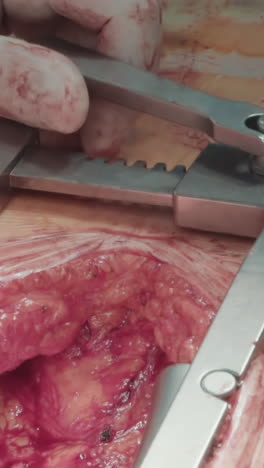 el médico prepara la arteria con un dilatador quirúrgico. el cirujano utiliza una herramienta quirúrgica para preparar la arteria coronaria asegurando una cirugía de derivación exitosa en un entorno hospitalario estéril