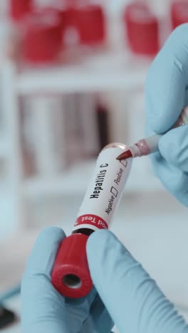 healthcare professional examining hepatitis c blood test tube in clinic