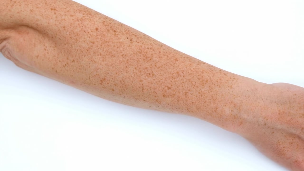 Primer plano de un antebrazo de piel clara con pecas que se extiende diagonalmente desde la parte superior izquierda hacia la inferior derecha, con la mano parcialmente visible a la derecha.
