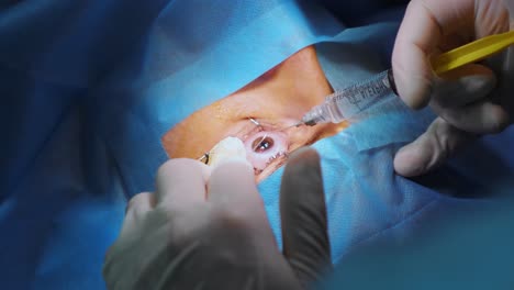 laser vision correction. a patient and team of surgeons in the operating room during ophthalmic surgery. eyelid speculum. lasik treatment. patient under sterile cover