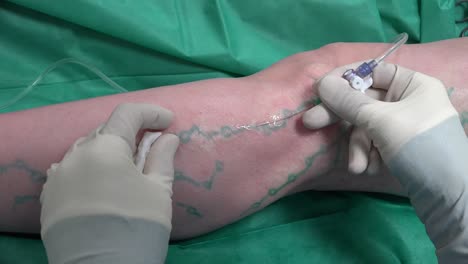 cirujano vascular está marcando venas para cirugía varicosa y analgesia