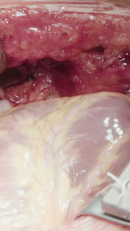 cavidad torácica abierta con retractores. esparcidores de costillas para una cirugía efectiva acceso abierto al corazón durante el injerto de bypass de la arteria coronaria en el hospital