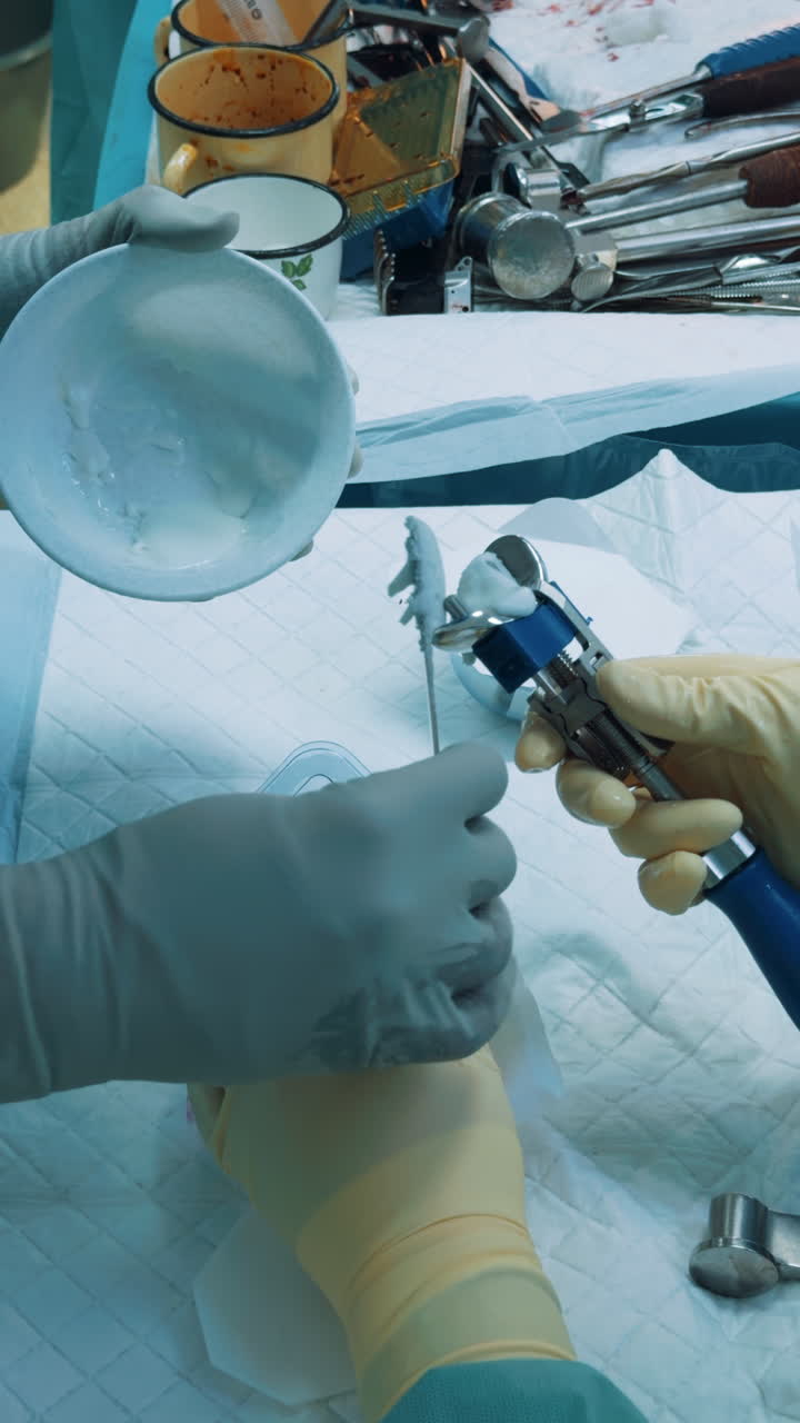 Surgeon's gloved hands preparing bone cement in a small bowl with a metal spatula. A vertical close view of the orthopedic material preparation during a joint replacement surgery