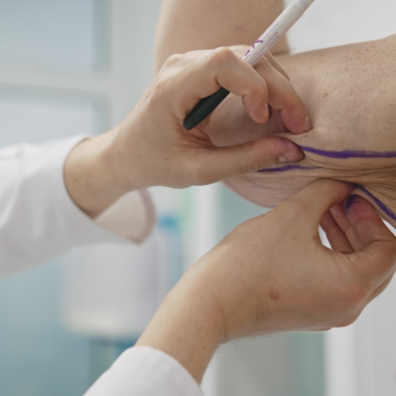 Plastic surgeon prepares a patient for liposuction surgery. Doctor draws lines on the male body with a marker