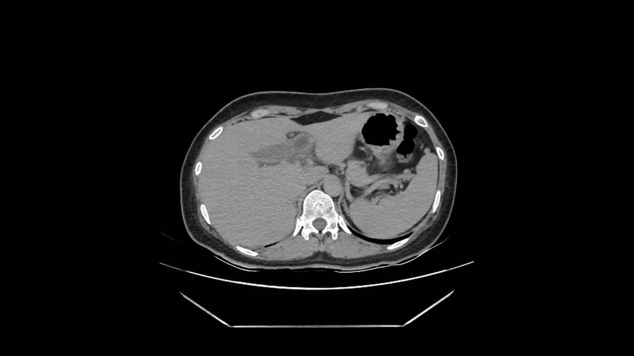 Ct scan analysis of appendicitis and gallstones in patients medical imaging healthcare clinical environment