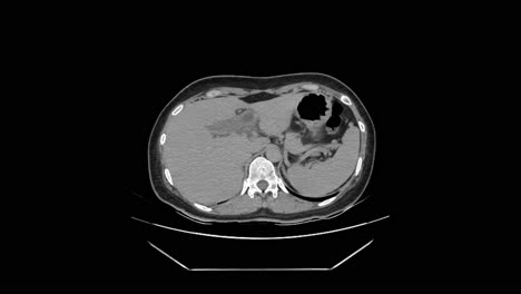 ct scan analysis of appendicitis and gallstones in patients medical imaging healthcare clinical environment