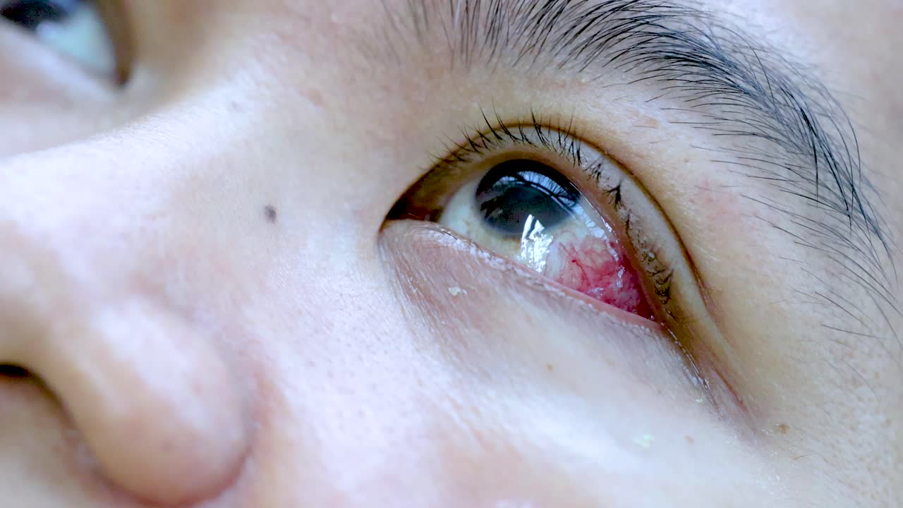 Detailed macro close-up of inflamed, teary eye with conjunctival redness under bright, even lighting