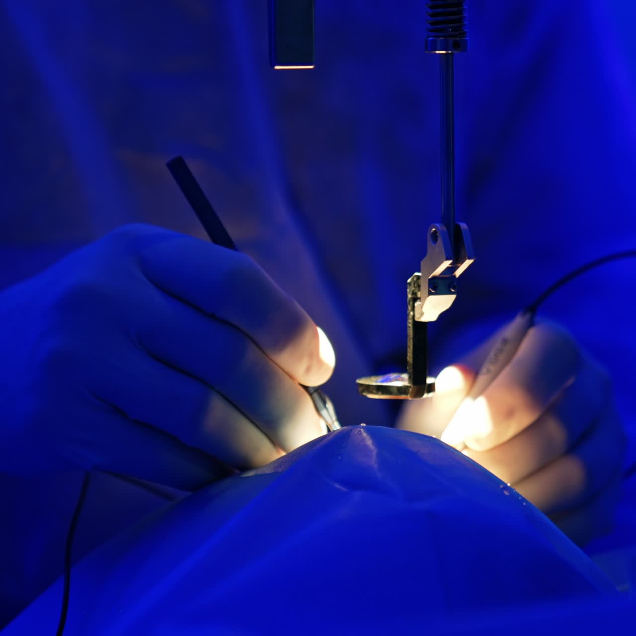 Surgery on the eye. Doctors work in the blue light surgical room. Operational spot is highlighted. Assistant's hand uses a syringe