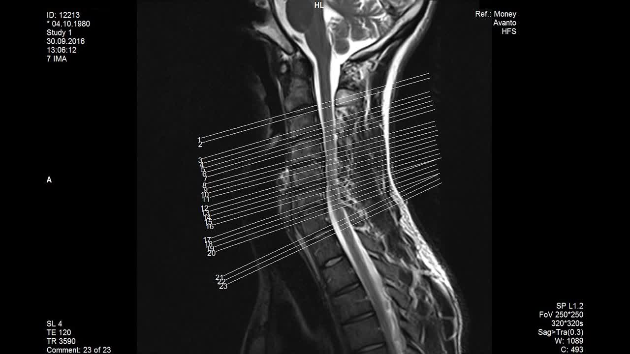 resonancia magnética de la columna lumbar que muestra los tamaños