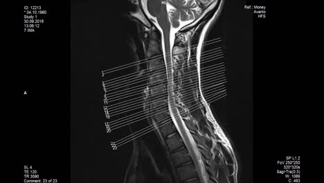 resonancia magnética de la columna lumbar que muestra los tamaños