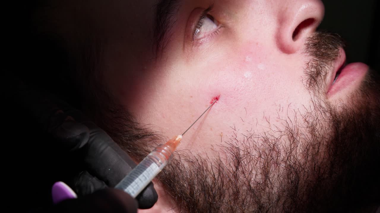 Close-up of Man's Face Receiving Facial Injection