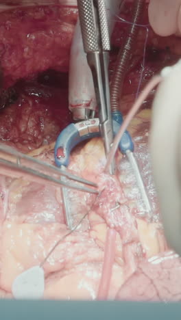 el médico con micro pinzas opera la cavidad. la mano del cirujano injerta cuidadosamente los vasos cosechados en las arterias coronarias de cerca. cirugía complicada