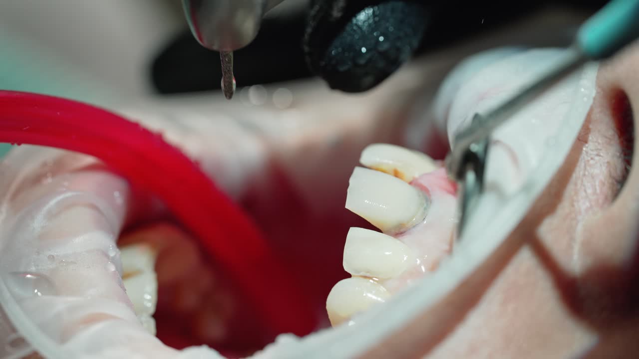 Dentist taking care of painful tooth. Woman on the operation in the dental office