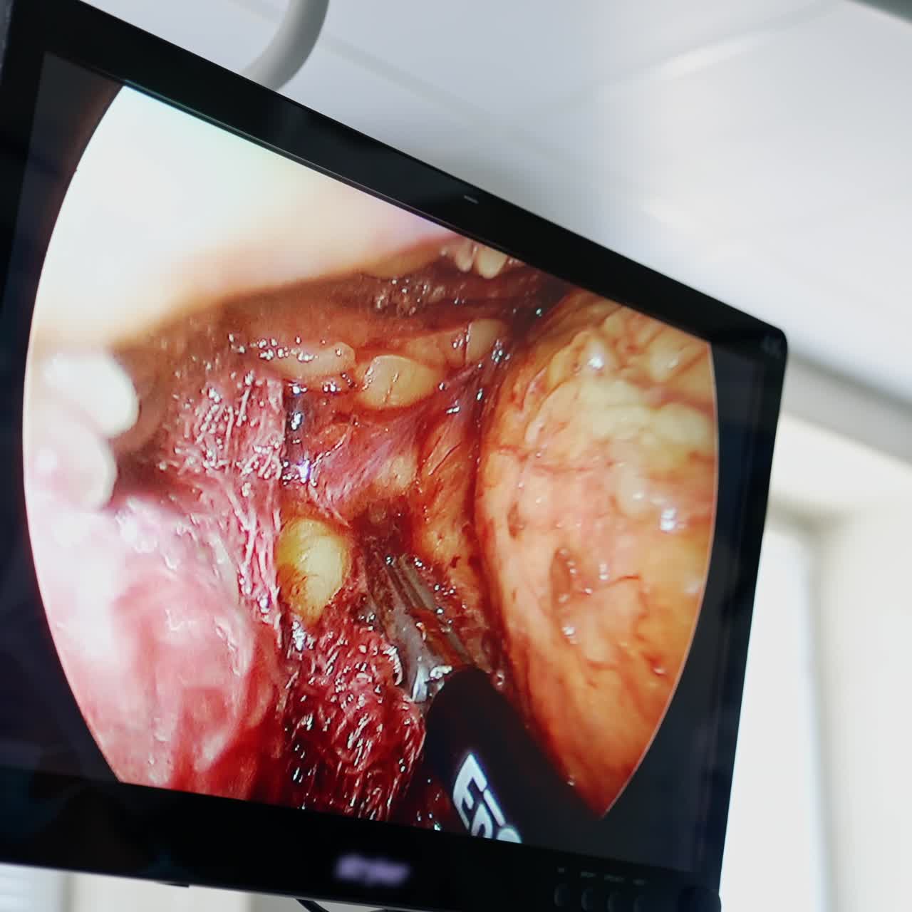 Surgical monitor during operative procedure. Screen showing medical process of surgeon's intervention to inner patient's organs. Close-up