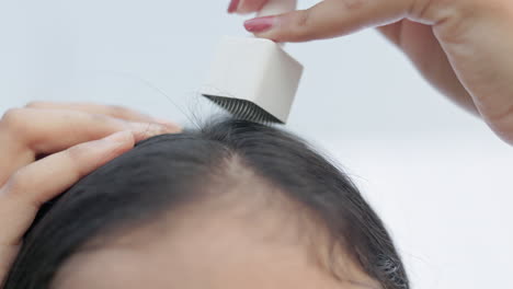 microneedling treatment, androgenic alopecia, a woman using derma stamp on alopecia head to treat hairloss and stimulating new hair growth.